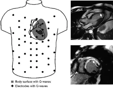 Fig. 2. Body surface map of a patient with anterior infarction. Left panel:ECG signal is directly focused to the nearer anterior electrodes withoutscattering