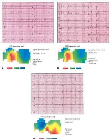 FIGURE 3. Examples of BSMs and 12-lead electrocardiograms from patients with AMI conﬁrmed by elevated troponin I or creatinekinase-MB.lead ECG algorithm (maximamamissed by physician and 12-lead ECG algorithm (maxima (A) Patient with inferior AMI diagnosed 