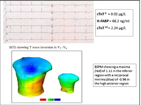 Fig. 2. Patient with cTnT less than 0.03 μwithin 15 minutes of 12-lead ECG shows inferior territory STE