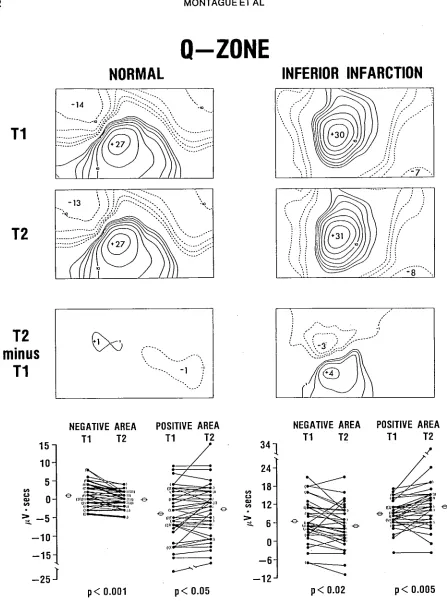 Fig. 3. Comparison of mean initial (T1), follow-up (T2) and difference (T2 - T1) Q-zone maps from 42 normal subjects 