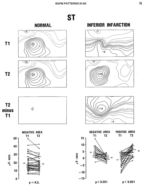 Fig. 4. Comparison of mean initial (T1), follow-up (T2) and difference (T2 - T1) ST-segment maps of 42 normal sub- 