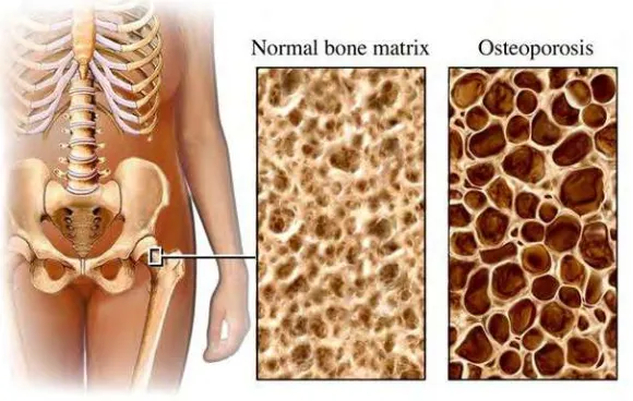 Gambar 2.2 Tulang Normal dan keropos (Health P.,2012) 