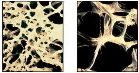 Figure 2.4 The trabecular architecture of normal bone (left) is lost in osteoporotic bone (right)(Kalpakcioglu ..et al., 2008) 