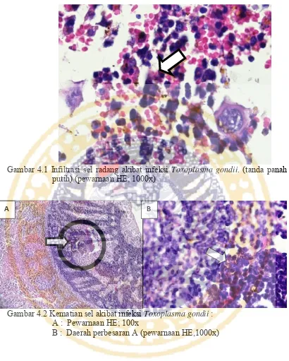 Gambar 4.1 Infiltrasi sel radang akibat infeksi  Toxoplasma gondii. (tanda panah 