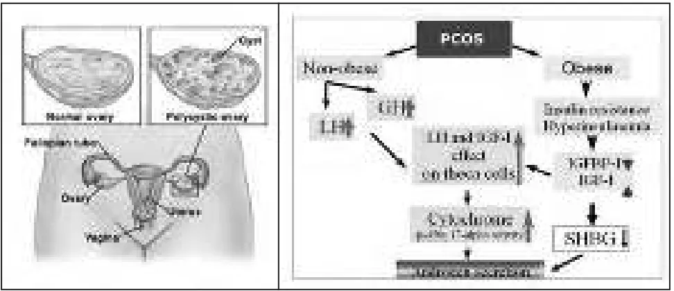 Gambar 1. PCOS