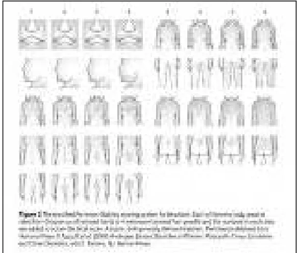 Gambar 3. Hirsuitism pada PCOS