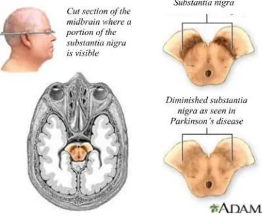 Gambar 2.1 Gambaran substantia nigra pada kondisi normal dan penyakit Parkinson  (Campellone, 2014) 