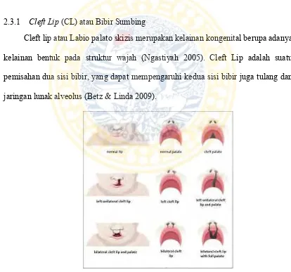 Gambar 2.0-3 Gambar Cleft Lip (Mossey P 2009) 