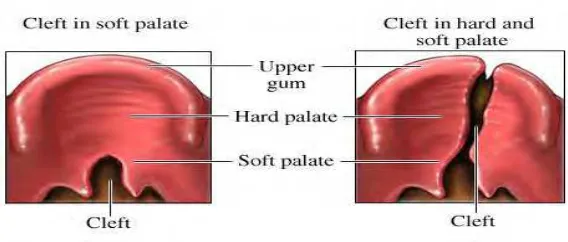 Gambar 2.0-4 Anatomi Cleft Palate (Michael dan Arden 2008) 