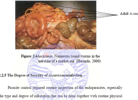 Figure 2.4Ascariasis. Numerous round worms in the 