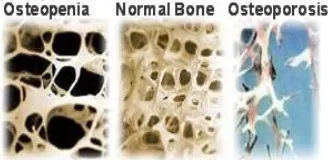 Gambar 2.2  Tulang Osteopenia, Normal, dan Osteoporosis 