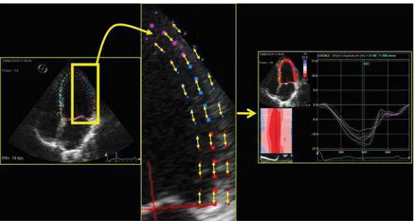 Gambar 2.2 Speckle Tracking Echocardiography (STE), gambar di atas 
