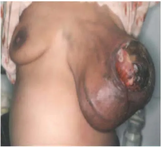 Gambar 2.3 Giant phyllodes tumor (SP Mishra et al, 2013,) 