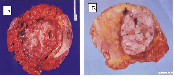 Gambar 2.4 tumor Phyllodes Benign . A : Stroma padat dan celah menyilang B : Tumor lobulated (Rosen, 2009) 