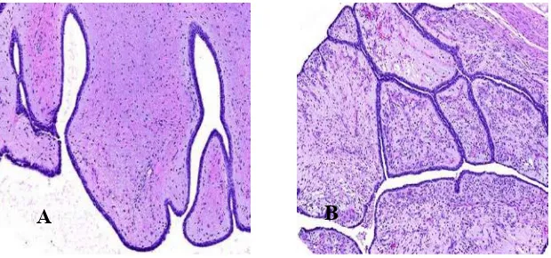 Gambar 2.7  Sitologi Tumor phyllodes. (A). Menunjukkan hiperseluler dengan branching. (B)