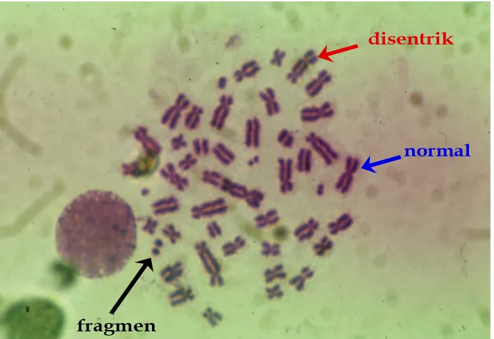 Gambar 1. Struktur kromosom normal, kromosom disentrik dengan fragmen asentrik pada  sebuah sel darah limfosit yang mempunyai 23 pasang kromosom