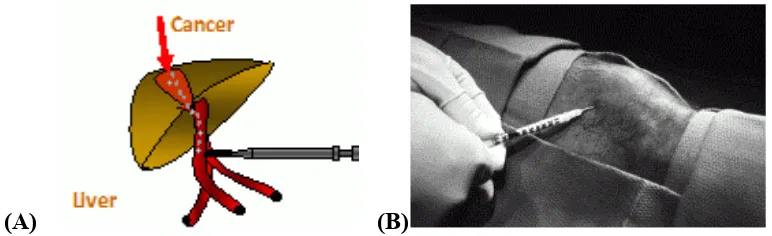 Figure 1 shows application examples of micro and nanosphere containing demonstrated the application of nanosphere for rheumatoid therapy, known as radiosynovectomy (RSV)[3]