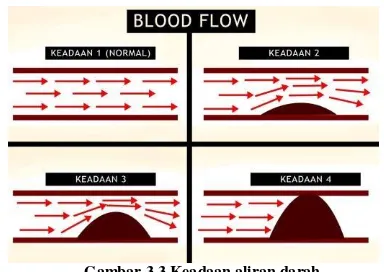 Gambar 3.3 Keadaan aliran darah berbeda dari aliran darah dalam arteri. Pada keadaan 1 gambar (3.3), dimana keadaan darah dalam keadaan normal  dan  aliran  darah  mengalir  normal  tanpa adanya halangan atau penyempitan