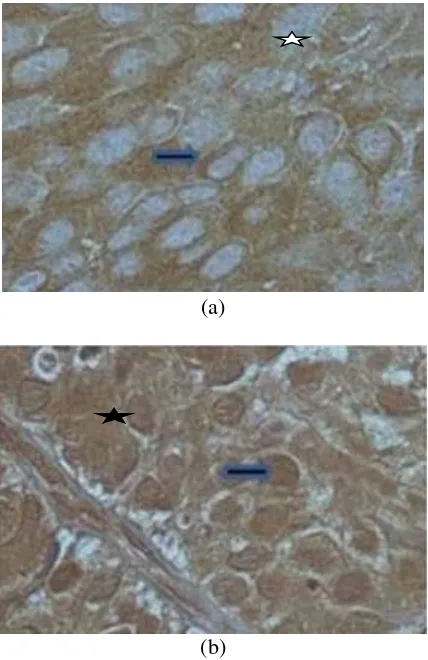 Fig 1. Expression of  p70s6k in cytoplasm (a) and nucleus            (b) in cervical cancer before treatment with radiotherapy (original magnification 10×40)