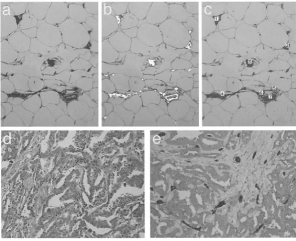 Figure 1. Immunostaining of normal breast tissue with the pan-endothelial marker0.09)breastprovidecountautomaticallyCD31segmentaion (b), the endothelial-lined vessels with positive immunostaining are outlined and counted (c)