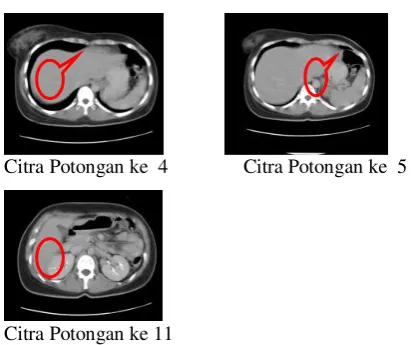 Gambar 1. Citra Slice Liver. 