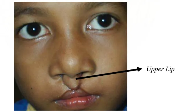 Gambar 2. Kerusakan upper lip pada PBSB. 