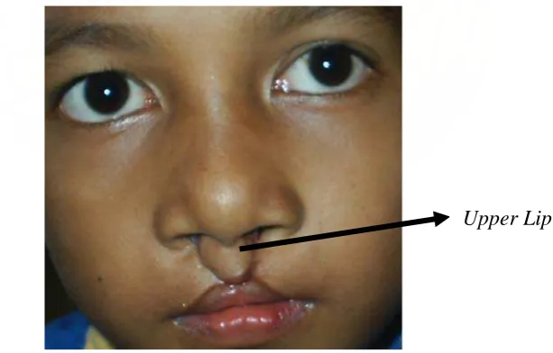 Gambar 2. Kerusakan upper lip pada PBSB. 