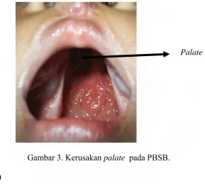 Gambar 3. Kerusakan palate  pada PBSB. 