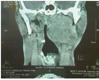 Figure 1. Coronal CT scan of parapharyngeal  mass showed  left parapharyngeal mass.  