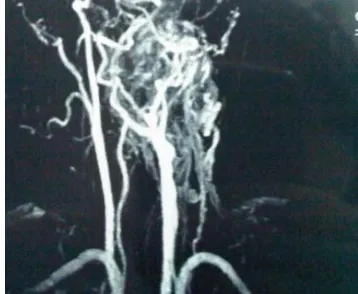 Figure 2.  Sagittal CT scan of parapharyngeal mass.   