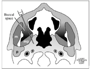 Figure 5. Schematic diagram shows the buccal space and biopsy needle. .m= masticator muscle;  mp =  medial pterygoid muscle; p=  parotid gland