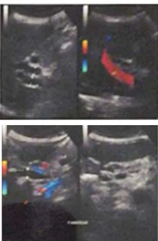 Figure 1. Abdominal ultrasound showed hepatomegaly, dilatation of intra and extra hepatic bile duct and the pancreatic duct which was suspected caused by an obstruction in the distal common bile duct (CBD) (due to mass with strictures as the differential diagnosis)