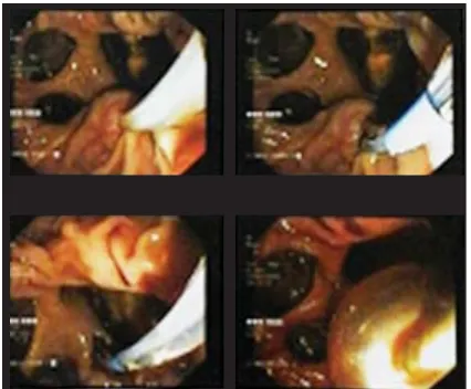 Figure 4. Endoscopic Sphincterectomy showed the stent was removed