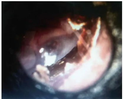 Gambar 8. Pemeriksaan otoskopi 3 bulan pasca-operasi menunjukan membran timpani utuh. 