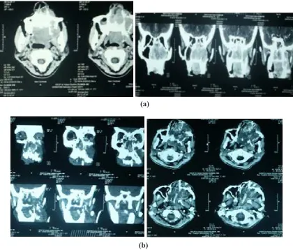 Gambar 2. CT Scan sinus paranasal (a) sebelum radioterapi, (b) sesudah radioterapi