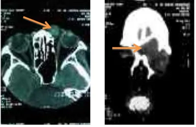 Gambar 1. CT Scan kepala potongan koronal dan aksial