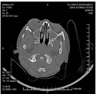 Gambar 1. CT-Scan temporal