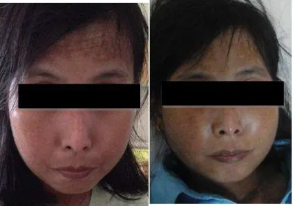 Gambar 4. Profil pasien: kiri adalah hari kedua  perawatan, kanan: hari kesepuluh perawatan