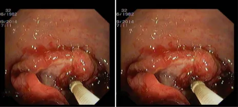 Figure 4. Endoscopy examination showed an internal hemorrhoid, anular mass, fragile, tend to bled in rectum, suspect of malignancy