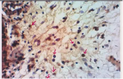 Gambar 2. Sel yang mengekspresi  HSP70 (anak  panah merah) setelah terapi, pada pengecatan  imunohistokimia terhadap HSP70 dengan antibodi spesifiknya