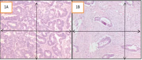 Figure 1. Slide with HE staining showing the least invasive part from primary tumour. Tumour cell should be present in all sides Figure 1