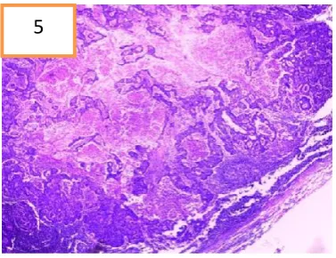 Figure 5. Metastasis to lymph node. (HE,2,5X)