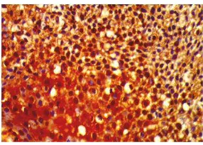 Gambar 1.  Pengecatan HE pada karsinoma nasofaring undifferentiated dengan pembesaran 400x pada mikroskop Obtilab Olympus CX.21 yang difoto dengan software ka-mera Scopelmage 9.0 (H1C).