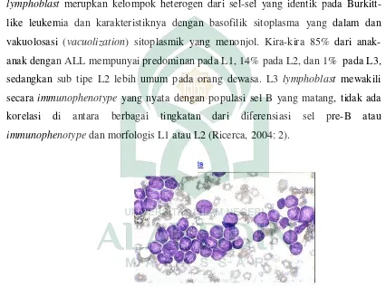 Gambar II. 6 : ALL1 lymphoblast (Ricerca, 2004: 3). 