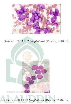 Gambar II.7 : ALL2 lymphoblast (Ricerca, 2004: 3). 