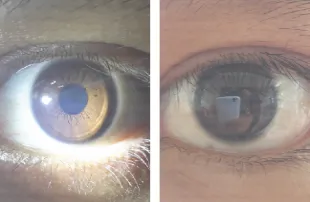 Figure 5. Capture eyes using additional light and not 