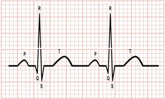Figure 1. A two periods of normal ECG wave. The vertical small box represents the voltage of heartbeat electricity in 0.1 millivolts and the horizontal small box represents the time in 0.04 seconds