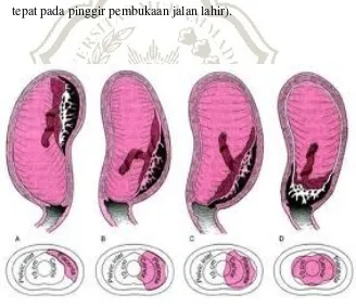 Gambar 2.3. Plasenta Previa 