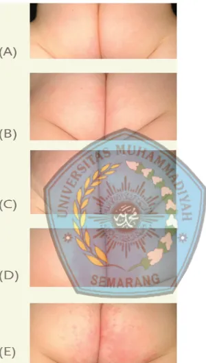 Gambar  2.2  Ilustrasi Derajat Diaper Dermatitis:(A) Sangat Ringan, 