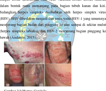 Gambar 2.9 Herpes Genitalis 